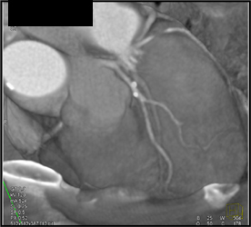 Calcified Plaque in LAD - CTisus CT Scan