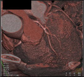 Calcified Plaque in LAD - CTisus CT Scan