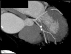 Calcified Plaque in LAD - CTisus CT Scan