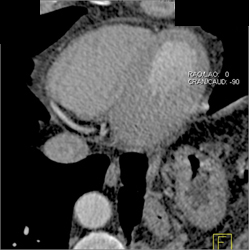 Normal RCA - CTisus CT Scan