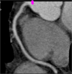 Normal RCA - CTisus CT Scan