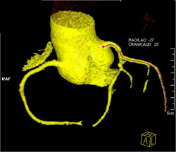 Minimal Plaque in Circumflex Artery (CX) - CTisus CT Scan