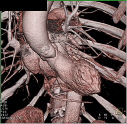 Aortic Root and Coronary Takeoff Displays?? - CTisus CT Scan