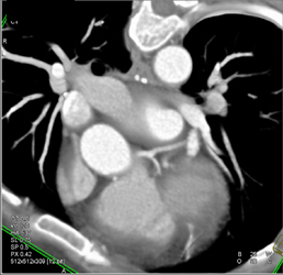 Minimal LAD Disease - CTisus CT Scan