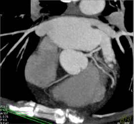 Minimal LAD Disease - CTisus CT Scan