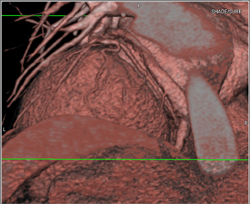 Circumflex Coronary Artery - CTisus CT Scan