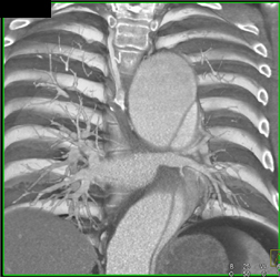 Type A Dissection and Aortic Valve Replacement (AVR) - CTisus CT Scan