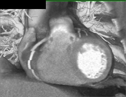 Wrong Phase of Reconstruction - CTisus CT Scan