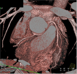 Nice Look at RCA and LAD - CTisus CT Scan