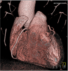 Normal RCA - CTisus CT Scan