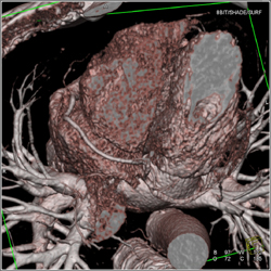 Normal RCA - CTisus CT Scan