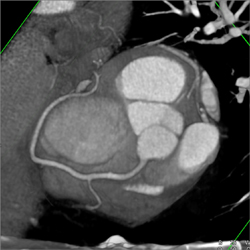 Nice 3D Display of RCA - CTisus CT Scan