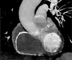 Diseased RCA - CTisus CT Scan