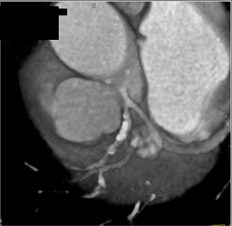 Diseased RCA - CTisus CT Scan