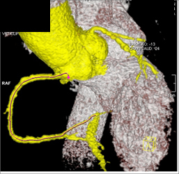 Diseased RCA - CTisus CT Scan