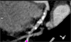 Diseased RCA - CTisus CT Scan