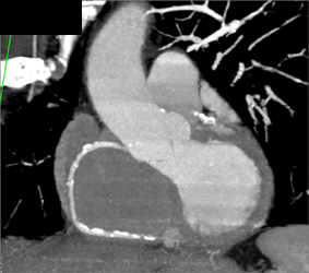 Diseased RCA - CTisus CT Scan