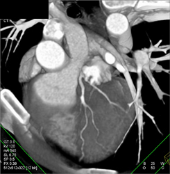 Pseudolesion in LAD By Poor 3D Rendering - CTisus CT Scan