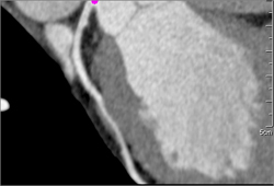 LAD Soft Plaque - CTisus CT Scan