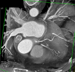 Trifurcation of CT Main Coronary Artery - CTisus CT Scan