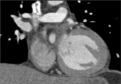 Artifact With Step Off - CTisus CT Scan