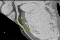 Computer Generated Stenosis Calculation - CTisus CT Scan