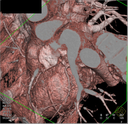 LAD Arises Off of Right Cusp - CTisus CT Scan