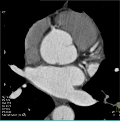 Normal LAD - CTisus CT Scan