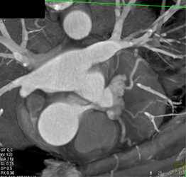 Nice Views of LAD - CTisus CT Scan