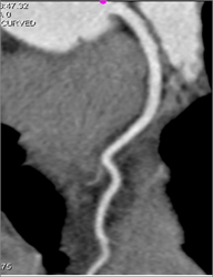 Normal LAD - CTisus CT Scan