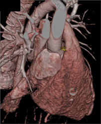 Atrial Appendage - CTisus CT Scan