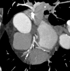 Diseased LAD - CTisus CT Scan