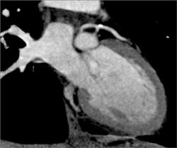 Diseased LAD - CTisus CT Scan