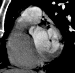 Diseased LAD - CTisus CT Scan