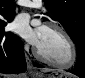 Diseased LAD - CTisus CT Scan