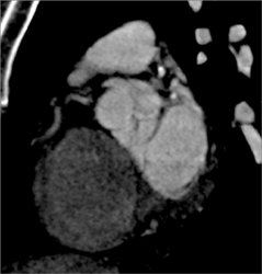 Diseased LAD - CTisus CT Scan