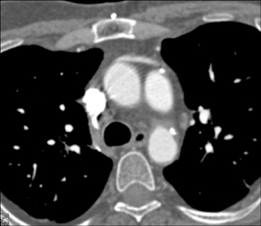 Coronary Artery Bypass Graft (CABG) Without Stenosis Or Occlusion - CTisus CT Scan