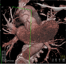 Aberrant Origin of LAD - CTisus CT Scan