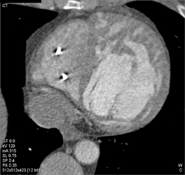 Corrected Transition of Great Vessels - CTisus CT Scan