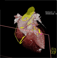 Patent Left Internal Mammary Artery (LIMA) Graft - CTisus CT Scan