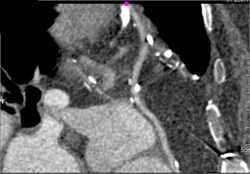 Patent Left Internal Mammary Artery (LIMA) Graft - CTisus CT Scan