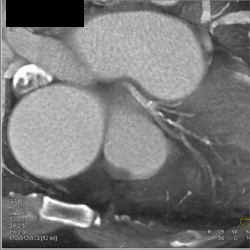 Diseased LAD - CTisus CT Scan