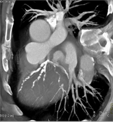 Diseased LAD - CTisus CT Scan