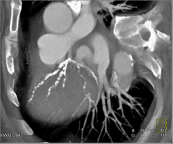 Diseased LAD - CTisus CT Scan