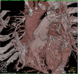 Diseased LAD - CTisus CT Scan