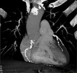 Extensive Disease in Coronary Arteries With Extensive Calcifications - CTisus CT Scan