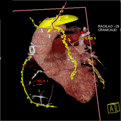 Patent Bypass Graft - CTisus CT Scan