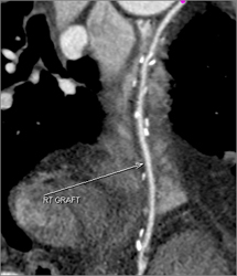 Patent Bypass Graft - CTisus CT Scan