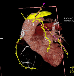 Patent Bypass Graft - CTisus CT Scan