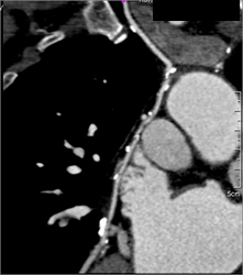 Patent Bypass Graft - CTisus CT Scan